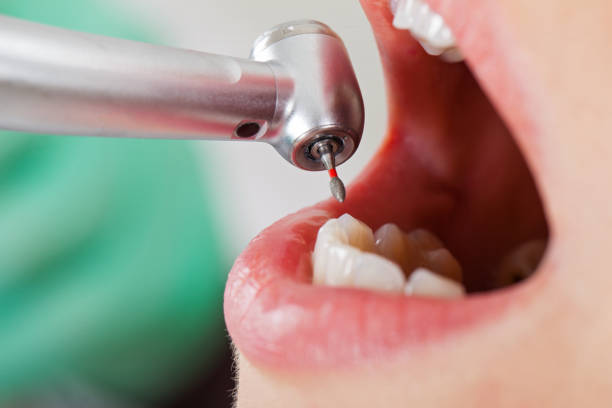 Best Emergency Wisdom Teeth Removal in , CA